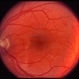 Recurrent Pseudotumor with Scleritis